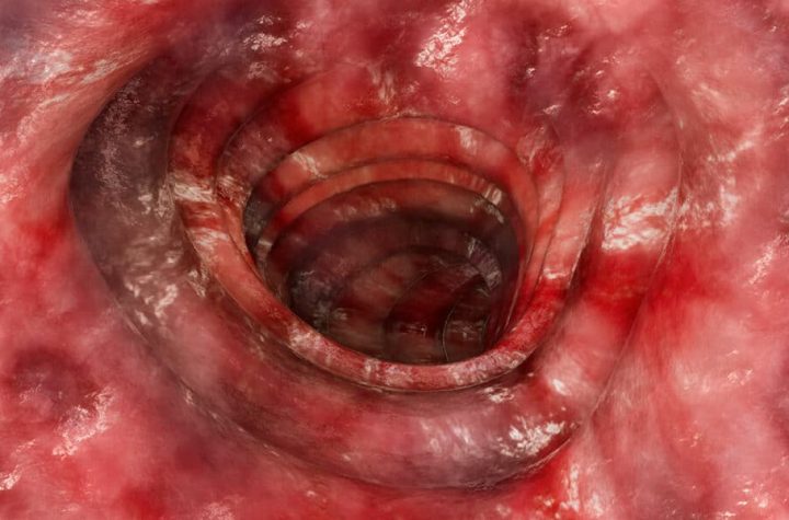 La CE da luz verde a Zeposia (ozanimod) para el tratamiento en adultos con colitis ulcerosa de moderada a grave