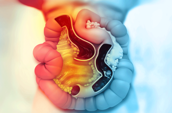 Los expertos celebran la llegada de un nuevo tratamiento para el cáncer colorrectal BRAF +, asociado a peor pronóstico y mayor riesgo de progresión