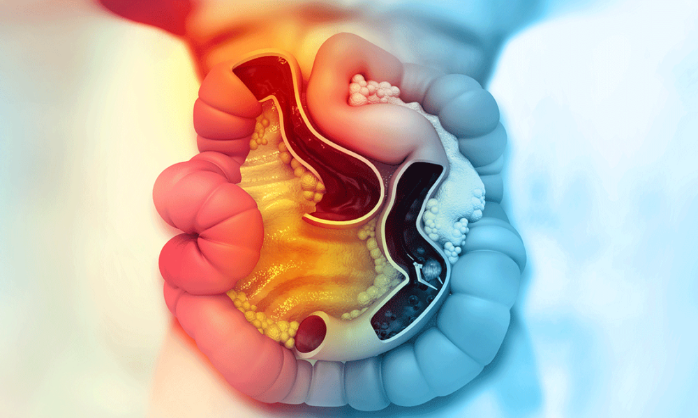 Los expertos celebran la llegada de un nuevo tratamiento para el cáncer colorrectal BRAF +, asociado a peor pronóstico y mayor riesgo de progresión