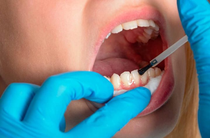 Como fortalecer el esmalte de los dientes