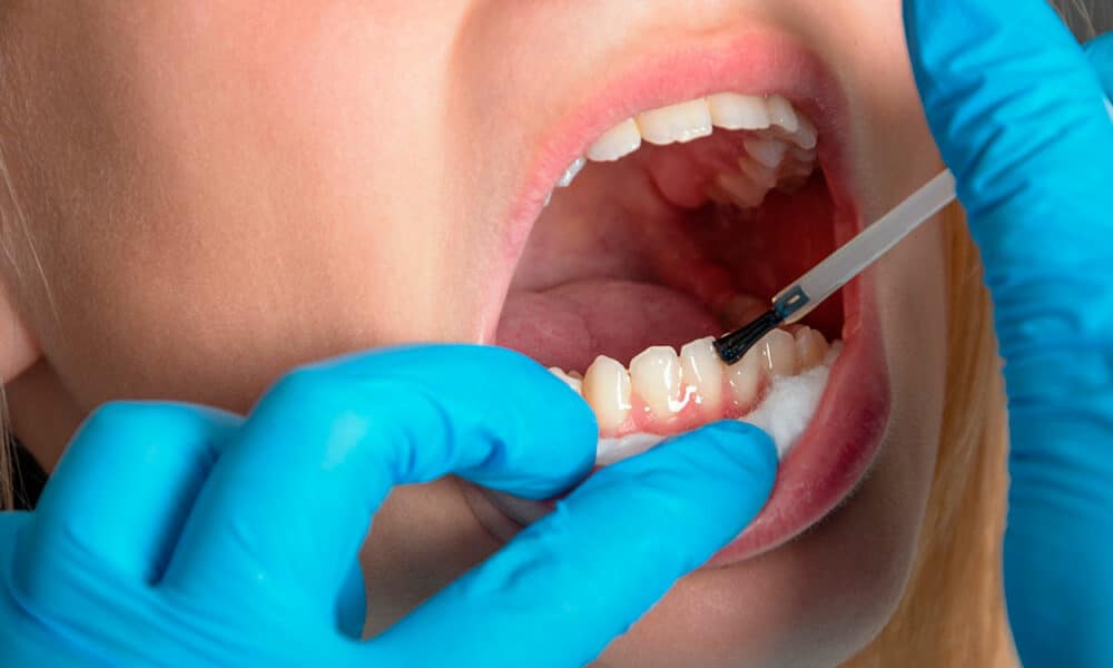 Como fortalecer el esmalte de los dientes