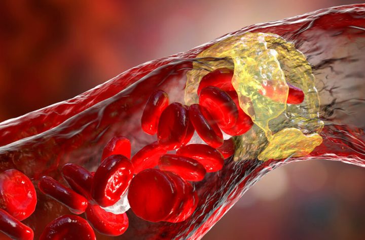 ¿Qué es la enfermedad arterial periférica?