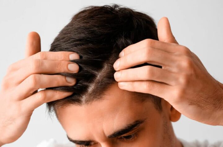 Mejor clinica de injerto capilar para la alopecia