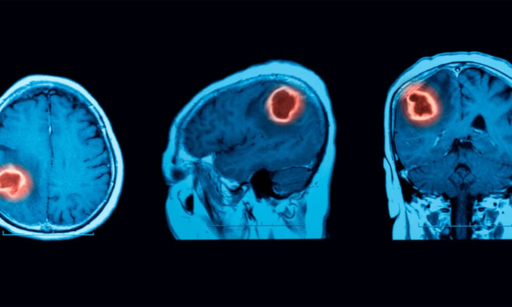 Logran una nueva técnica para tratar el tumor cerebral más letal con quimioterapia