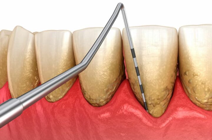 Las personas con periodontitis pueden tener el doble de riesgo de padecer Alzheimer y el triple de sufrir un ictus isquémico