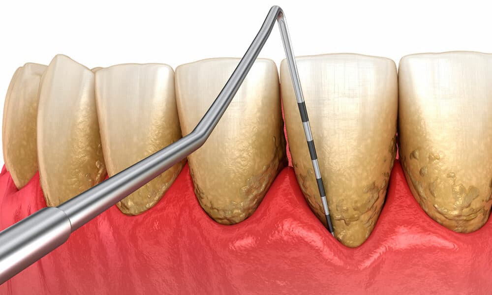 Las personas con periodontitis pueden tener el doble de riesgo de padecer Alzheimer y el triple de sufrir un ictus isquémico