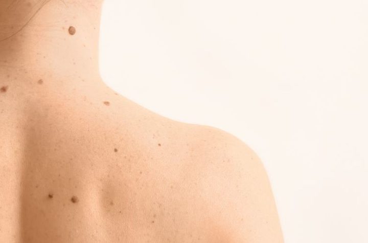 Cómo detectar lunares sospechosos y posibles melanomas con el método ABCDE