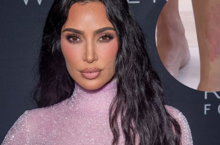 Kim Kardashian muestra su psoriasis en forma de corazón