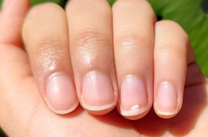 Manchas blancas en las uñas: ¿Mito del calcio o señal de alerta?  ¡Farmacéutico te lo explica!