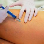 Fleboterapia Trap vs Tratamientos Tradicionales, ¿cuál es la mejor?